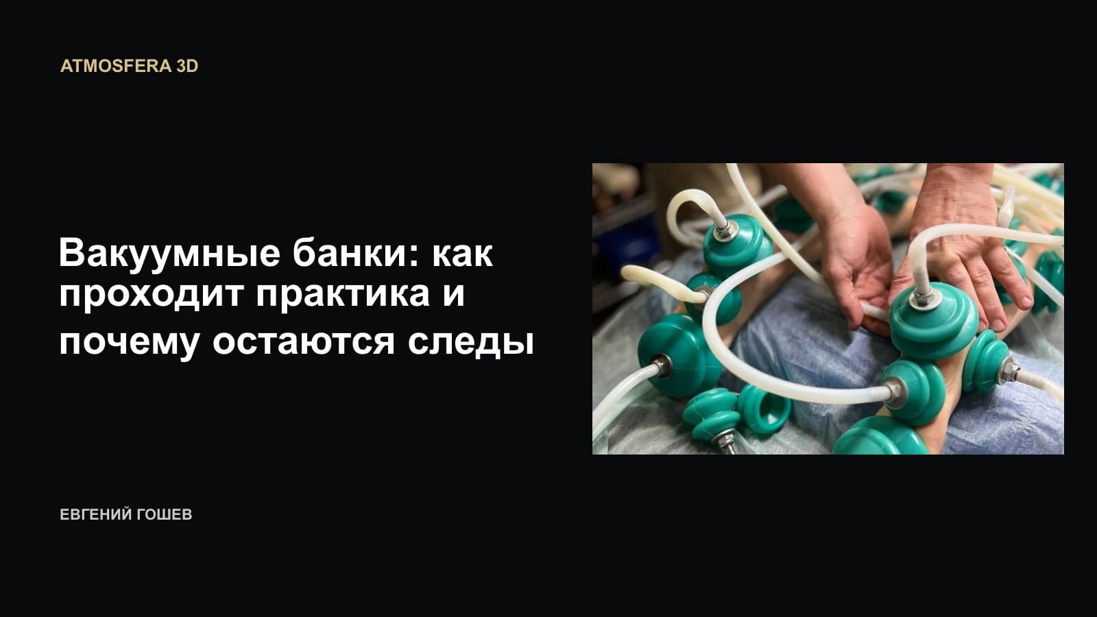 Вакуумные чаши, соединённые трубками, на коже; руки специалиста. Обложка статьи о практике и следах после банок.